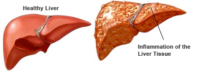 Image of a healthy liver and a diseased liver